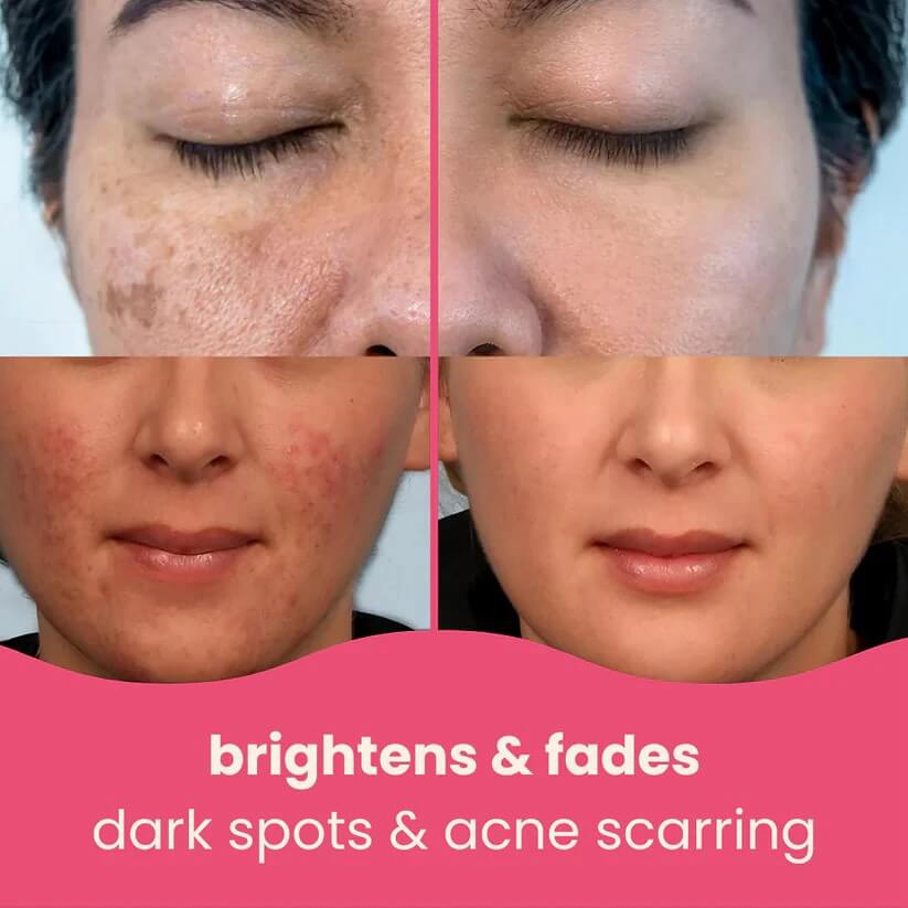 Final 3 Hours: Free Soap bar🔥 Brightening Turmeric & Kojic Acid Pads