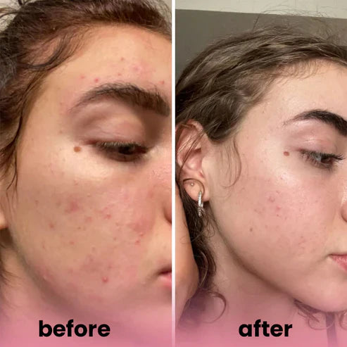 Turmeric kojic acid soap