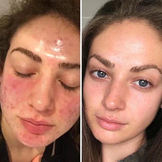 Final 3 Hours: Free Soap bar🔥 Brightening Turmeric & Kojic Acid Pads