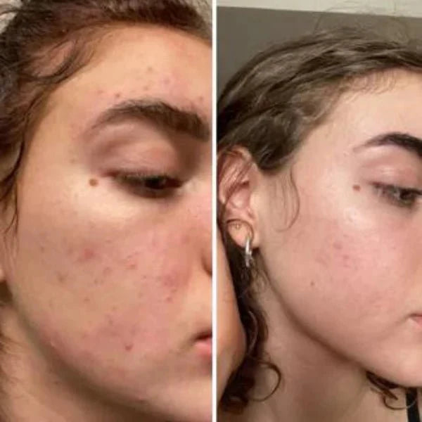 Final 3 Hours: Free Soap bar🔥 Brightening Turmeric & Kojic Acid Pads